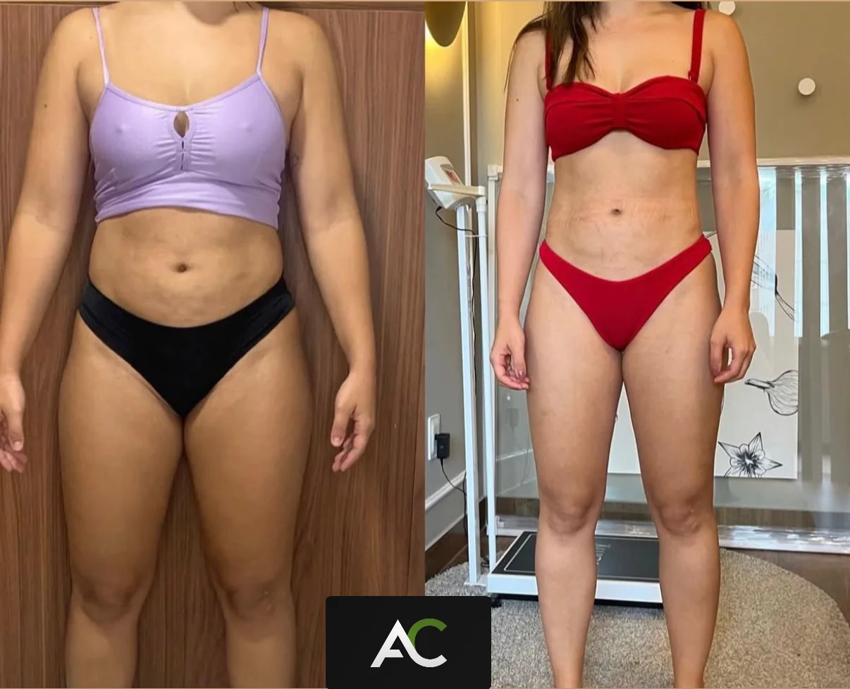 Antes e depois — aluna 01 do Método CTR